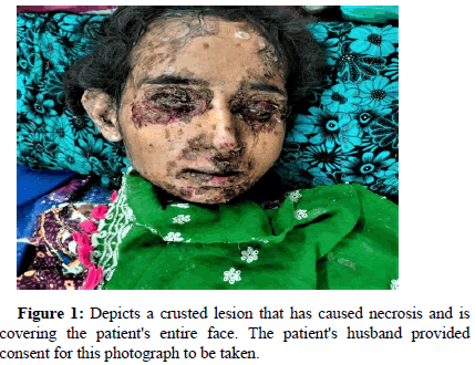 clinical-dermatology-necrosis