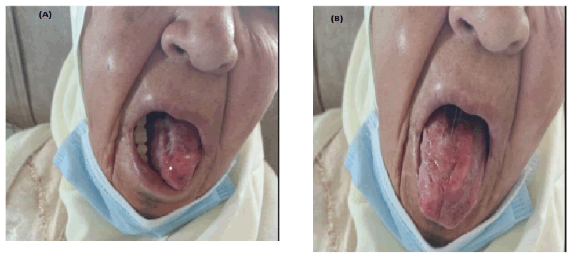 verrucous carcinoma palate