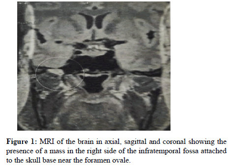diabetes-research-brain