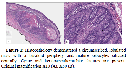 genetic-reports-basaloid