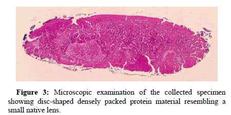 ophthalmic-pathology-protein