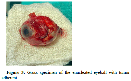 opthalamic-pathology-ball