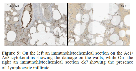 immuno-disease-acrome