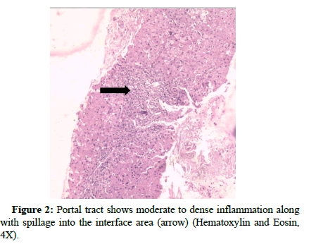 liver-transplant-eosin