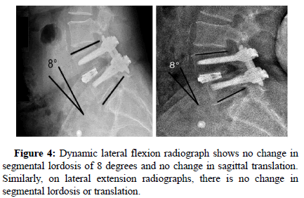 spine-neurosurgery-flexion