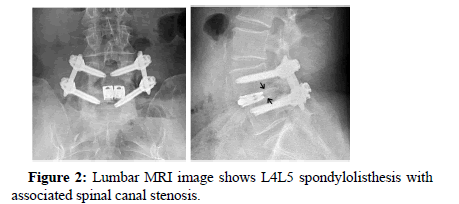 spine-neurosurgery-lumber