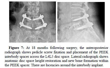 spine-neurosurgery-screw