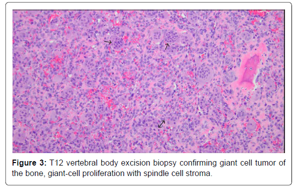 COCR-excision COCR-excision