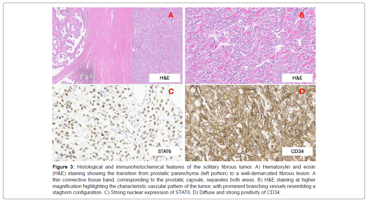 COCR-fibrous COCR-fibrous