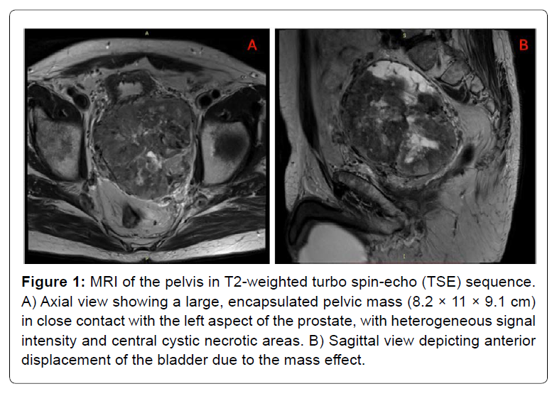 COCR-pelvis COCR-pelvis