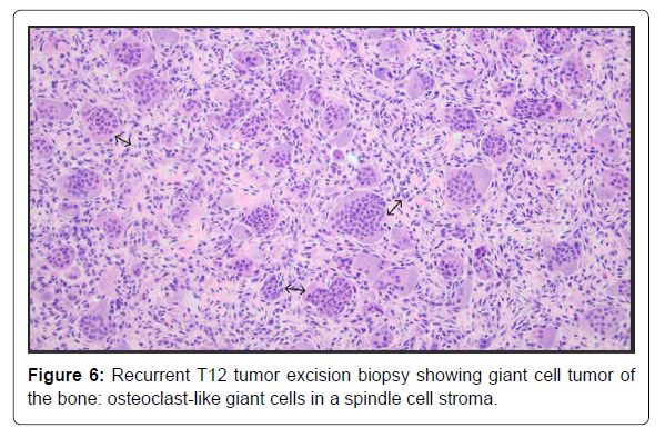COCR-tumor COCR-tumor