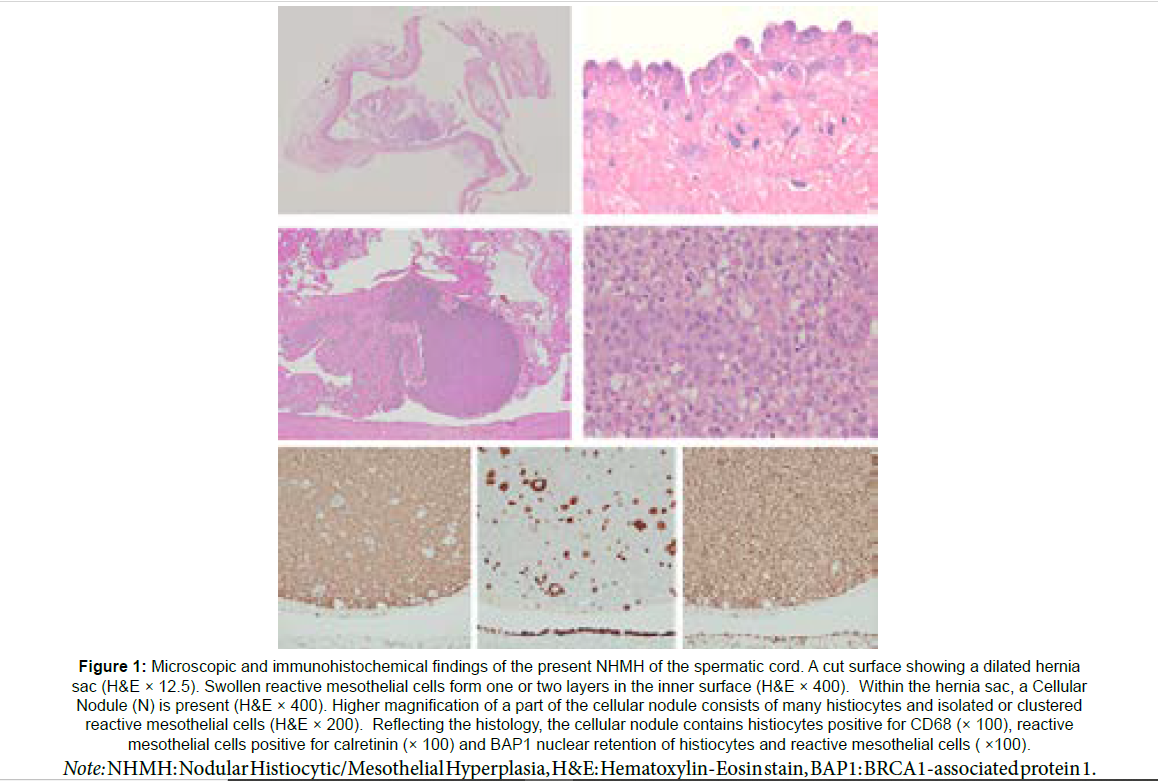 clinical-oncology-case-reports-immunohistochemical