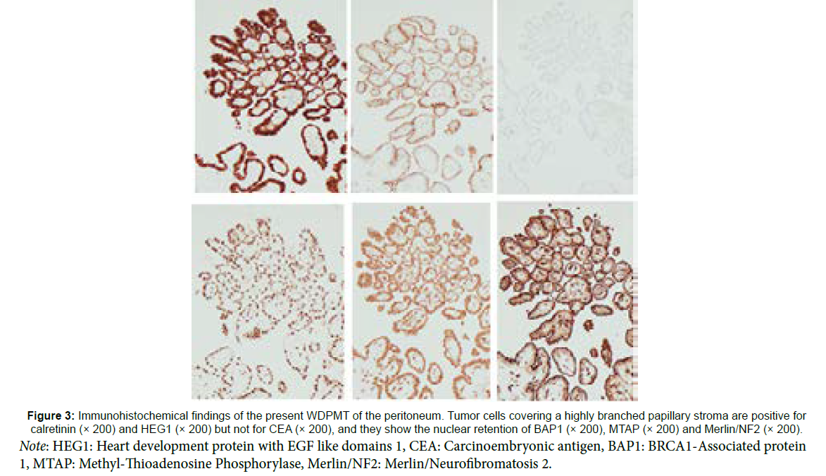 clinical-oncology-case-reports-peritoneum
