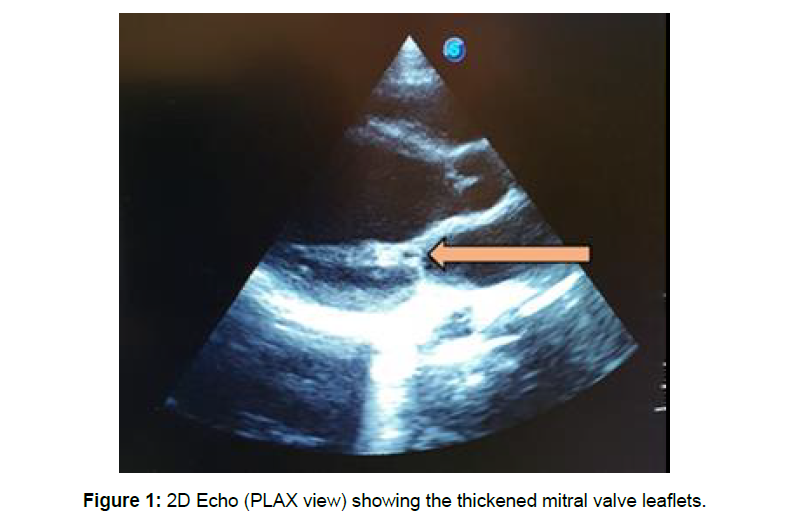 Cardiovascular-Research-thickened-mitral Cardiovascular-Research-thickened-mitral