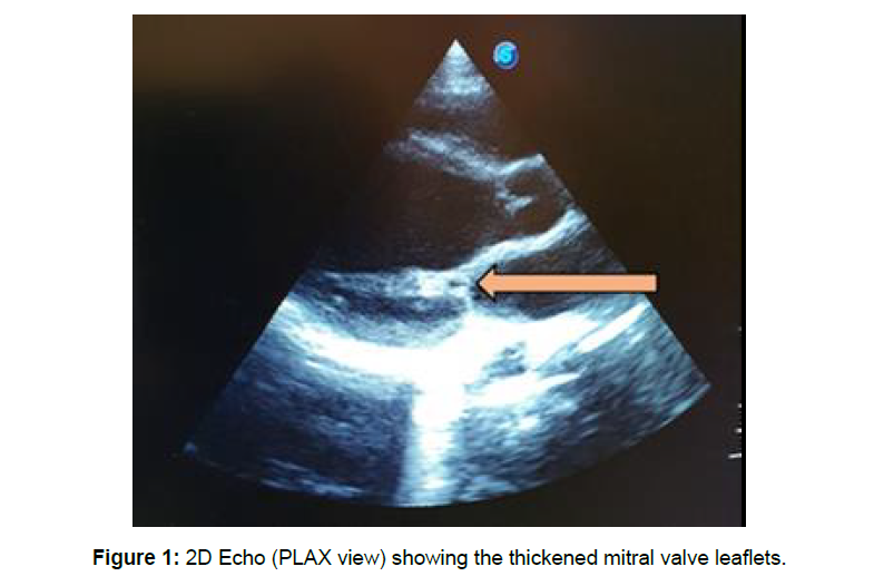 Cardiovascular-Research-thickened-mitral