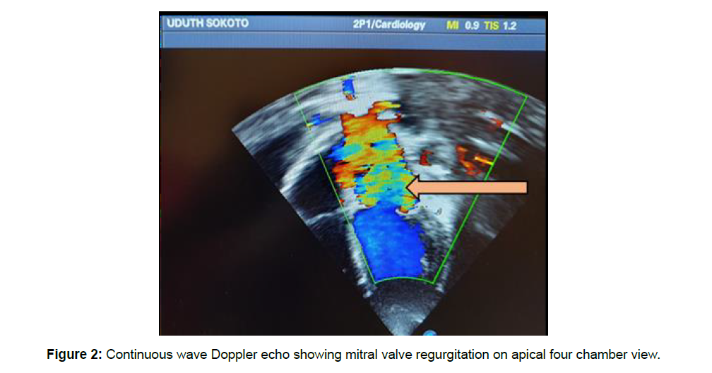 Cardiovascular-Research-valve-regurgitation