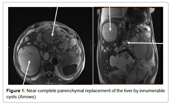 Liver-Transplantation-parenchymal-replacement