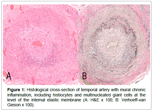 Ophthalmic-Pathology-histiocytes-chronic