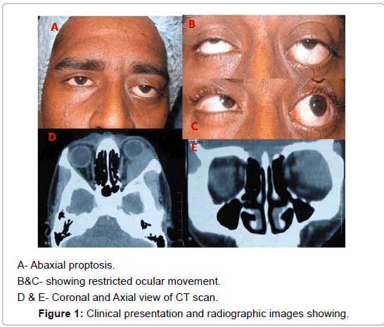 Ophthalmic-Pathology-ocular-movement