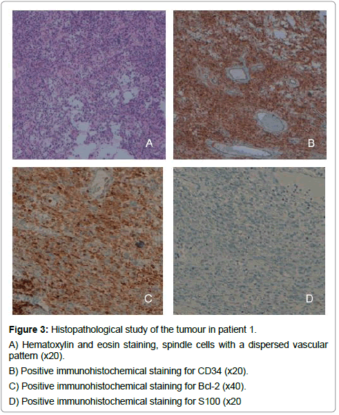 Ophthalmic-Pathology-spindle-cells