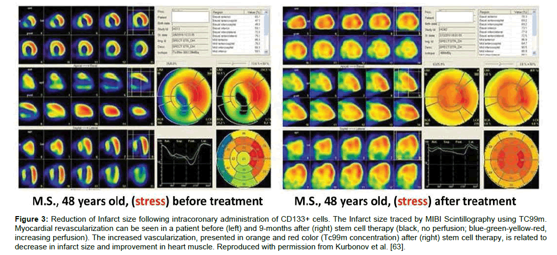 Regenerative-Medicine-Infarct-size