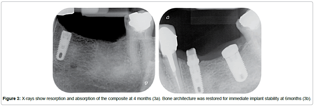 biomaterials-medical-applications-implant-stability