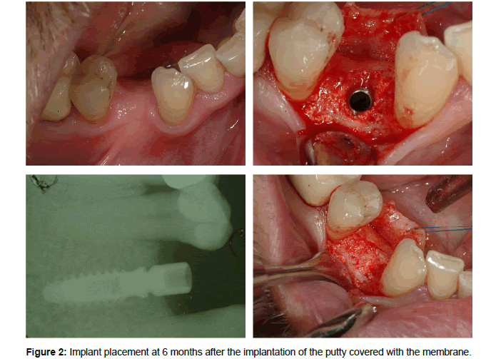 biomaterials-medical-applications-putty-covered