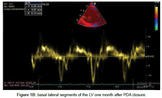 cardiovascular-research-PDA-closure