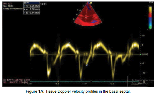 cardiovascular-research-Tissue-Doppler