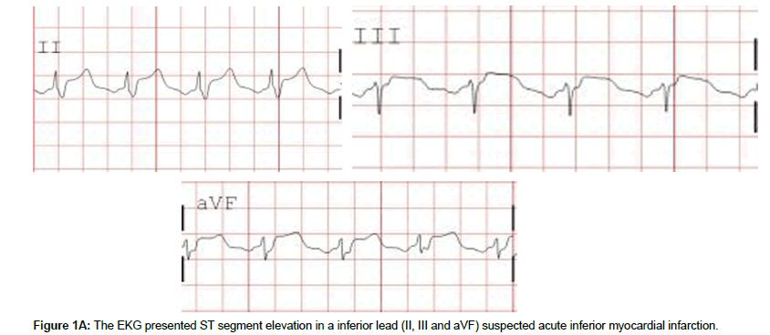 cardiovascular-research-acute-inferior