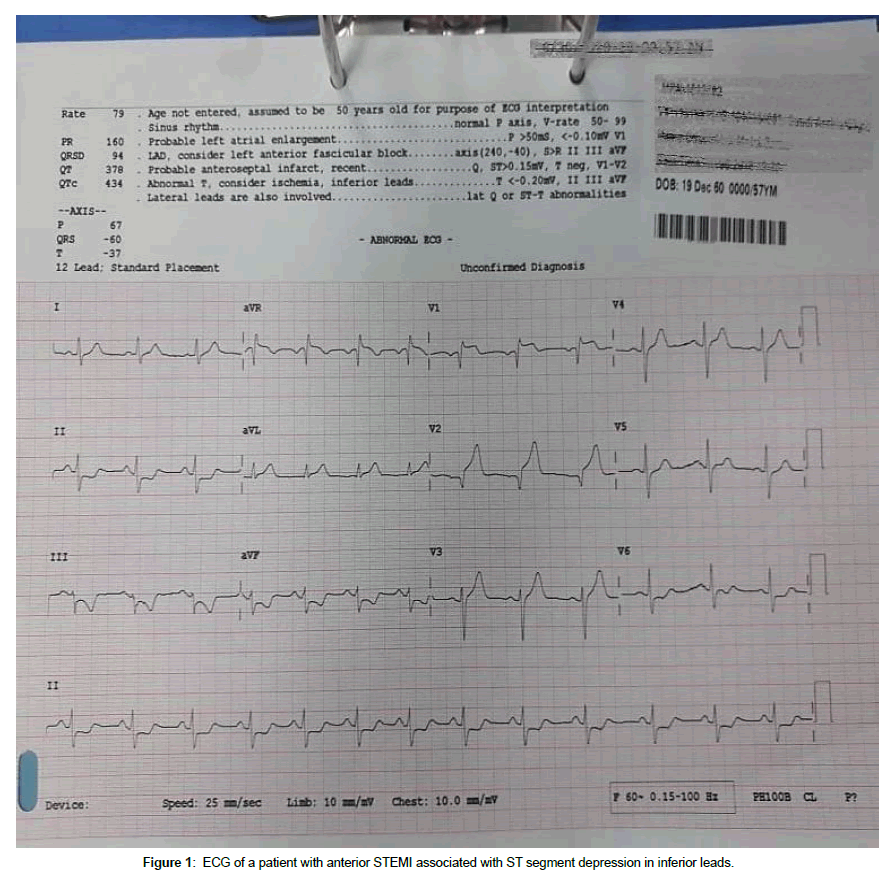 cardiovascular-research-segment-depression