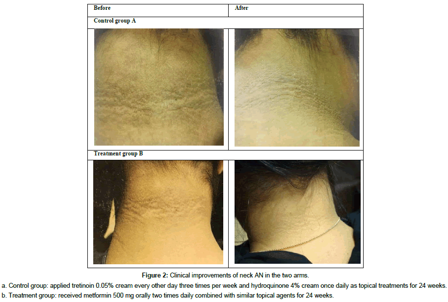 Treatment acanthosis nigricans 10 Types