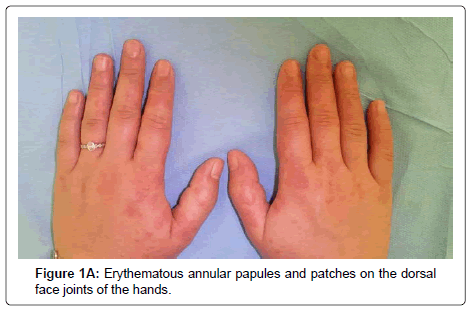 clinical-dermatology-Erythematous