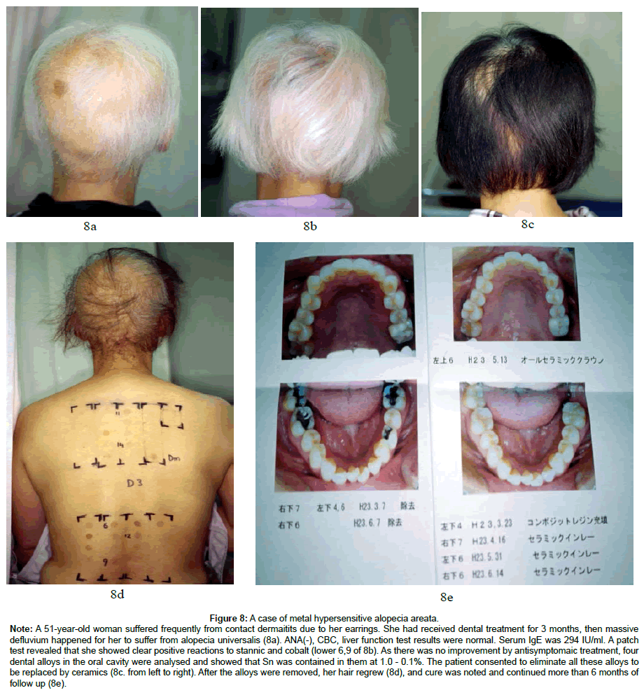 How to Treat Metal Hypersensitive Alopecia Areata and Atopic Alopecia |  SciTechnol