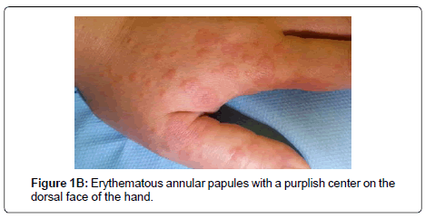clinical-dermatology-annular-papules