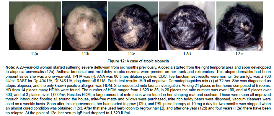 How to Treat Metal Hypersensitive Alopecia Areata and Atopic Alopecia ...