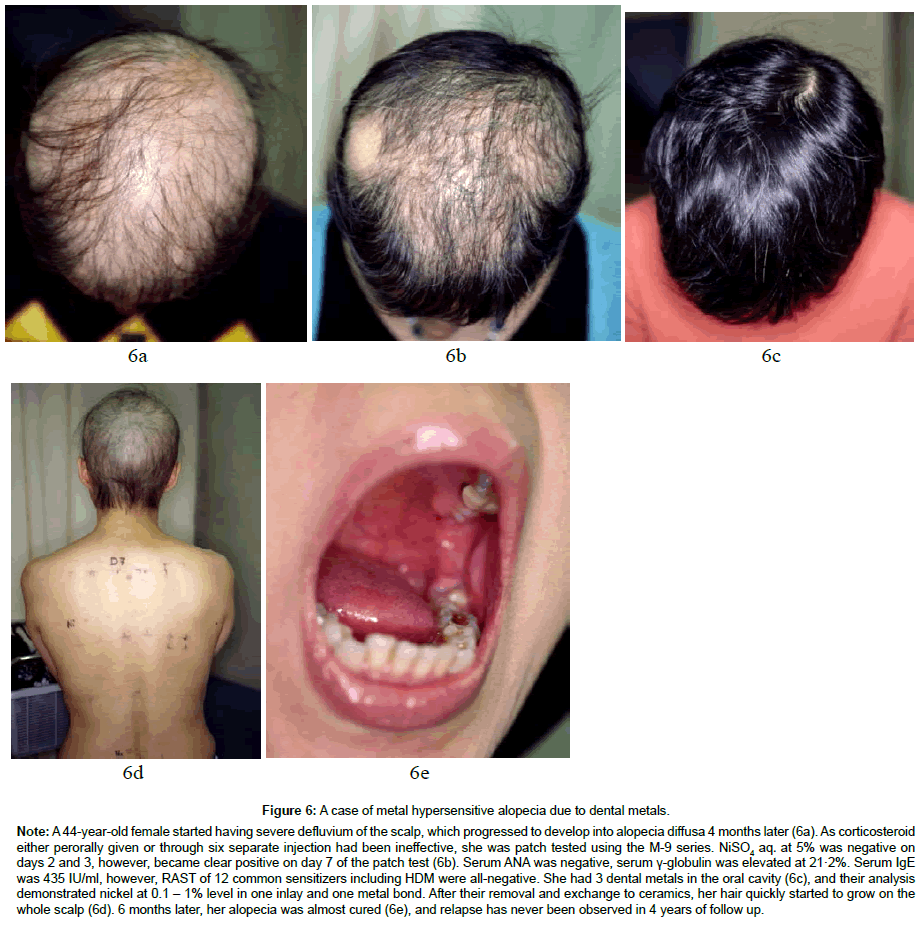 clinical-dermatology-dental-metals