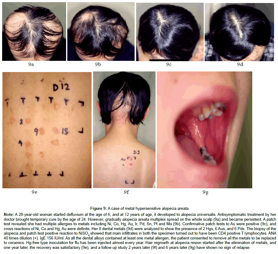 clinical-dermatology-metal-areata