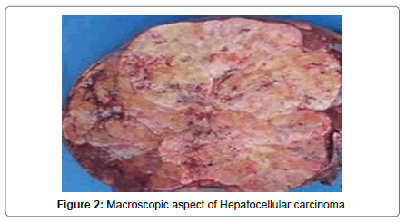 clinical-experimental-oncology-hepatocellular-carcinoma