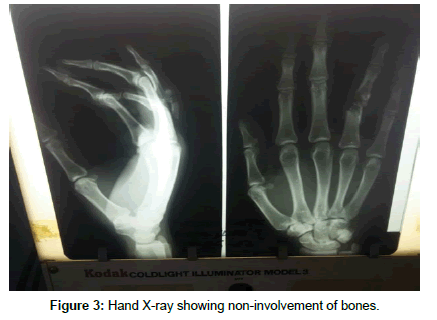 clinical-images-case-reports-Hand-X-ray