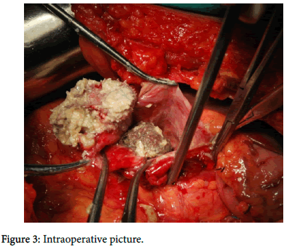 clinical-images-case-reports-Intraoperative