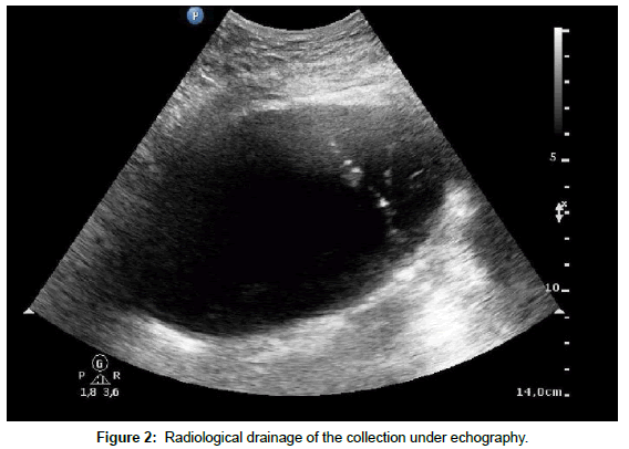 clinical-images-case-reports-Radiological-drainage