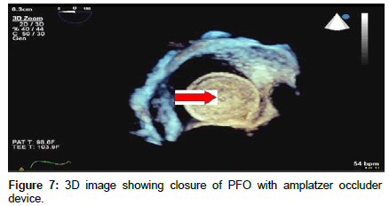 clinical-images-case-reports-amplatzer