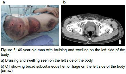 clinical-images-case-reports-bruising