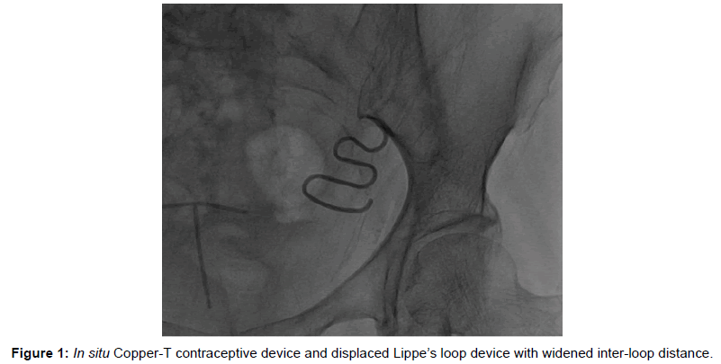 clinical-images-case-reports-contraceptive-device