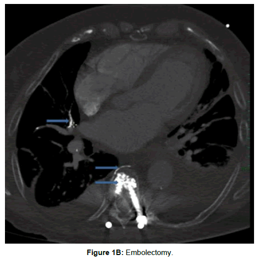 clinical-images-case-reports-embolectomy