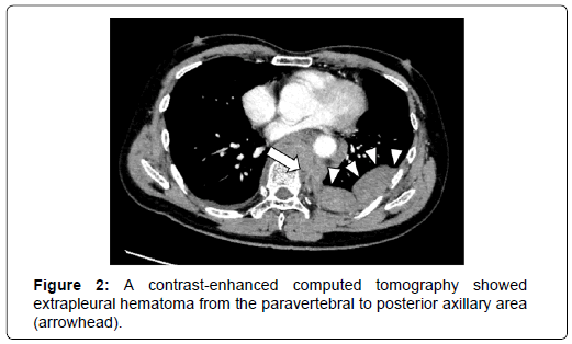 clinical-images-case-reports-extrapleural-hematoma