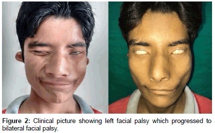 clinical-images-case-reports-facial-palsy