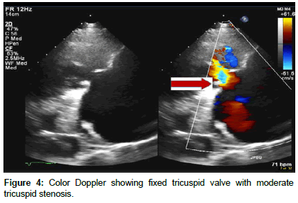 clinical-images-case-reports-fixed-tricuspid