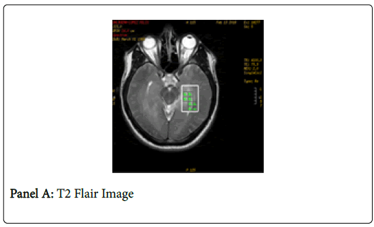clinical-images-case-reports-flair-image